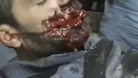 Facial injury as a result of explosive