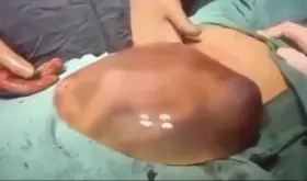 C-section baby born in amniotic sac