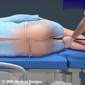 This is how a colonoscopy is performed.