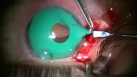 Removing Illegal Cosmetic Iris Implants [NSFW]