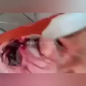 Right side of man’s face covered in maggots