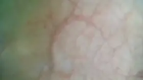 endoscope view inside my full bladder